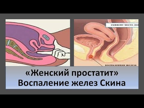 Видео: Воспаление парауретральных желез Скина у женщин. Женский простатит.