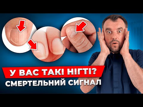Видео: Терміново перевірте це! Як по нігтям виявити ХВОРОБИ! швидка діагностика здоровʼя
