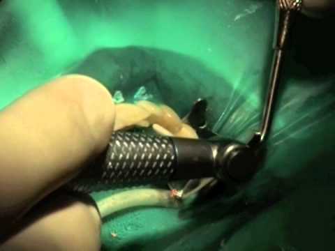 Видео: Восстановление зуба часть 2