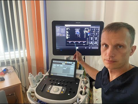 Видео: Steal syndrom + окклюзия ВСА + стеноз ВСА.