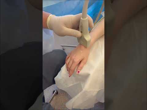 Видео: ЛЕЧЕНИЕ ГИГРОМЫ В МЦ SANTE