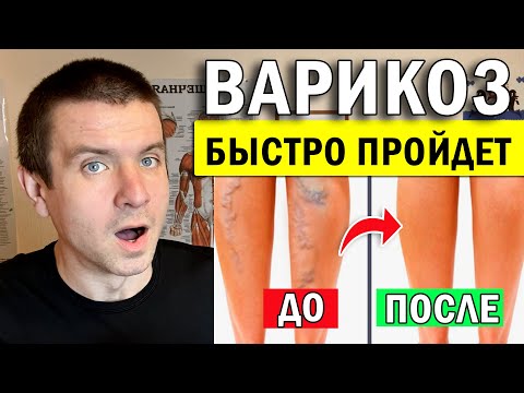 Видео: 🔥Лечение ВАРИКОЗА вен на ногах БЕЗ ЛЕКАРСТВ  в домашних условиях ✅ Упражнения от Андрея Лопеса