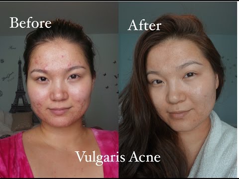 Видео: Үрэвсэлтэй батганаас салах аргууд | How to defeat Vulgaris Acne