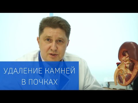 Видео: Эндоскопическая хирургия: удаление камней в почках без разрезов