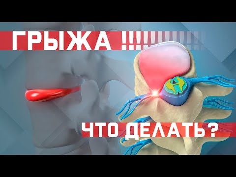 Видео: Как лечить межпозвоночную грыжу? Как жить с грыжей? Что с ней делать?