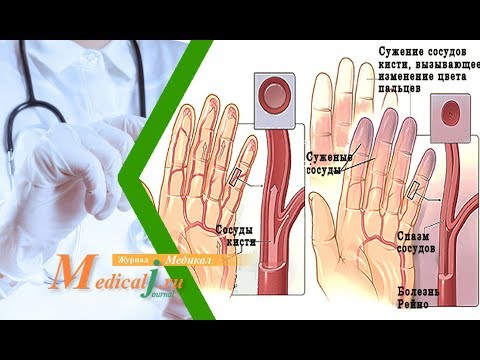 Видео: Болезнь Рейно. Причины, симптомы и лечение