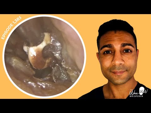 Видео: 1383 — Инородное тело, зарытое в инфицированных отходах, обнаружено и удалено