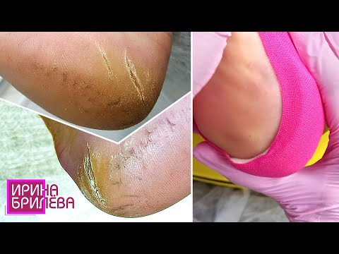 Видео: ЗАСТАВИЛИ прийти на ПЕДИКЮР 🌸 Разгрузка для пяток С БОЛЬШИМИ ТРЕЩИНАМИ 🌸 Ирина Брилёва