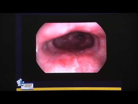 Видео: 20 Дрозд УА Радиочастотная абляция пищевода Барретта