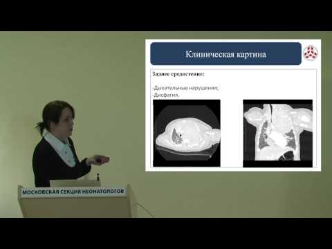 Видео: 6 ЗАСЕДАНИЕ (25.03.2015) Онкология. Нейробластома.