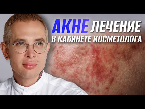 Видео: АКНЕ ЛЕЧЕНИЕ в кабинете косметолога | Роаккутан Сотрет опасность #акне #роаккутан #сотрет