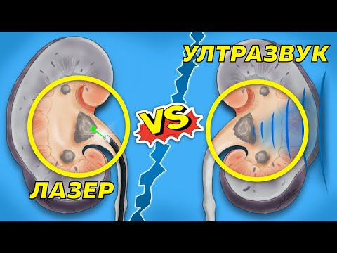 Видео: Лазер или Ултразвук - Кой метод е най-добър за разбиване на камъни в бъбреците?!