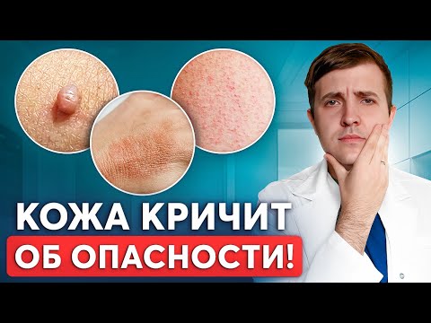Видео: Как кожа предупреждает о ВЫСОКОМ САХАРЕ? Срочно заметь это!
