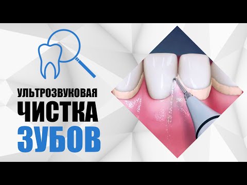 Видео: Ультразвуковая чистка зубов [ чистка зубов от камней и твердого пигментированного налета ].