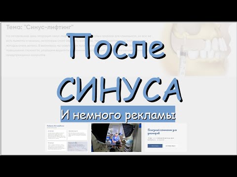 Видео: Имплантация после синуса