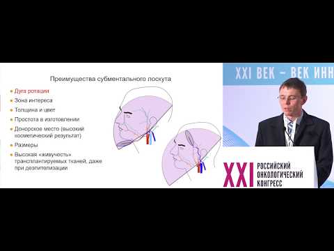 Видео: Возможности субментального лоскута в комбинированном лечении рака слизистой оболочки полости рта