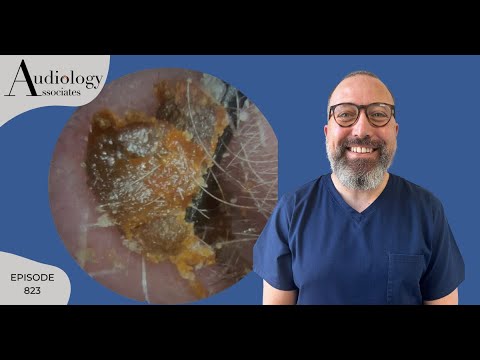 Видео: Жевательная резинка, ушная сера и кератиновый пилинг - EP823