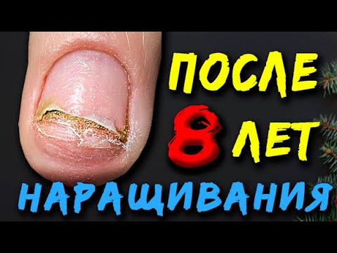 Видео: ОПАСНО!🚨 НОГТИ ОТПАЛИ. Вред НАРАЩИВАНИЯ! Спустя 8 лет.ОНИХОЛИЗИС.❌ Испортили Ногти.УЖАСНЫЙ МАНИКЮР