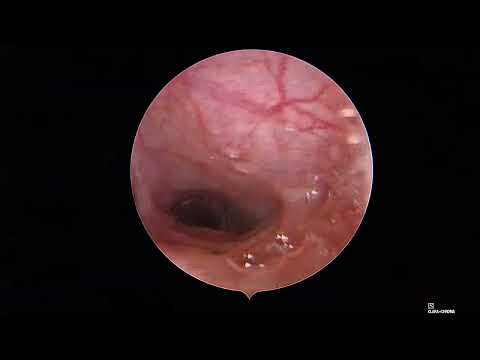 Видео: Коллапс трахеи, мальформация, стентирование