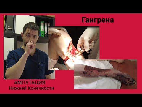 Видео: Гангрена. Ампутация нижней конечности.