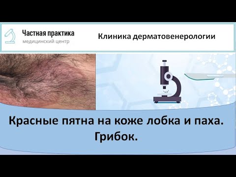 Видео: Красные пятна и шелушение на коже лобка и паха. Грибок паховой области.