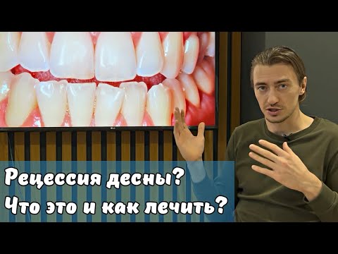 Видео: Dental Stories // Рецессия десны: что это и как это лечить? Рассказываю на примере моего пациента