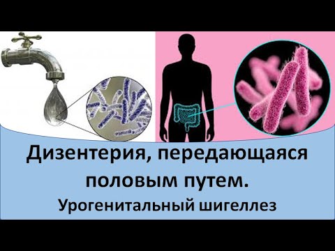 Видео: Дизентерия, передающаяся половым путем.  Урогенитальный шигеллез