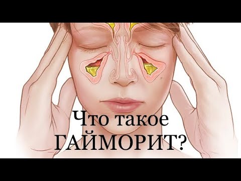 Видео: Острый гайморит