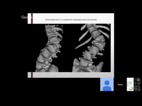 Видео: Вебинар "Рентгенодиагностика сколиоза"