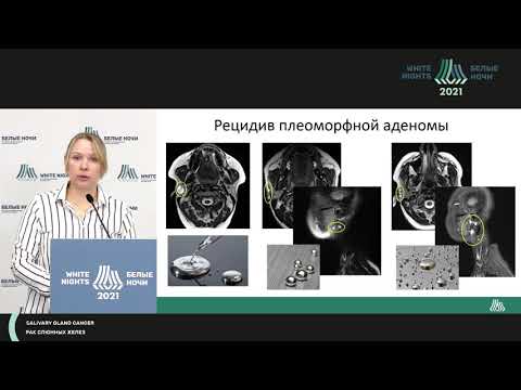 Видео: МР-картина малых  и больших слюнных желез (Пономарева О.И.)