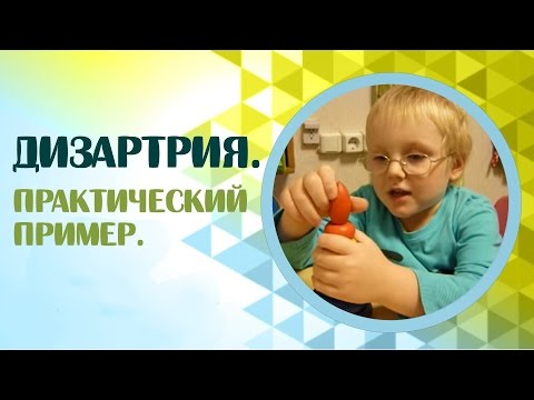 Видео: Дизартрия. Нарушение речи дизартрия. Практический пример дизартрии.
