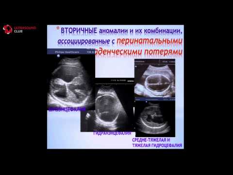 Видео: Постнатальные клинические результаты при различных эхографических вариантах аномалий головного мозга
