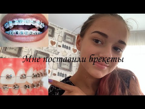 Видео: Мне поставили брекеты?