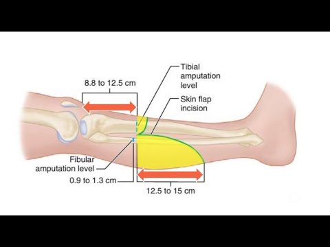 Видео: Транстибиальная ампутация ниже колена при ишемических конечностях