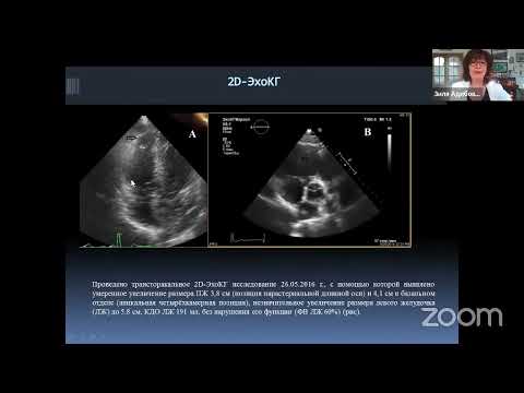 Видео: Трёхчастная сюита из малых форм аритмогенной кардиомиопатии правого желудочка