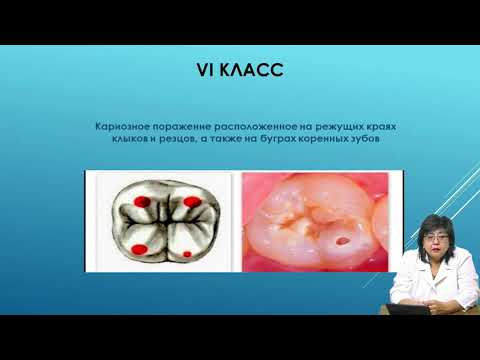 Видео: Кариес-понятие Классификация кариеса и кариозных полостей Теории кариеса