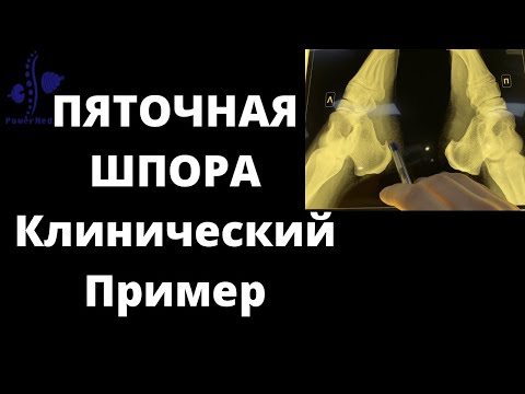 Видео: ПЯТОЧНАЯ ШПОРА | Плантарный Фасциит | ЛЕЧЕНИЕ, ДИАГНОСТИКА, КЛИНИКА