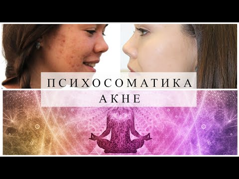 Видео: ПСИХОСОМАТИКА АКНЕ. Как избавиться от прыщей? #акне #проблемнаякожа #прыщи