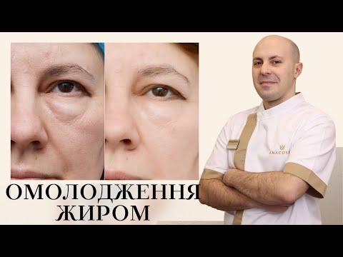 Видео: НАНОГРАФТИНГ VS ЛІПОФІЛІНГ ОБЛИЧЧЯ: ОМОЛОДЖЕННЯ ЖИРОМ 💉🔥 ЩО КРАЩЕ ⁉️