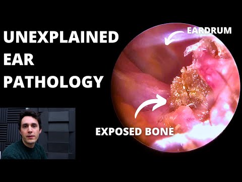 Видео: Доброкачественный некротизирующий наружный отит (3 случая)