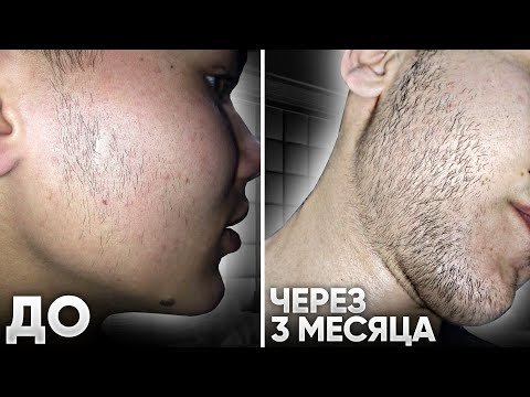 Видео: БУСТ ДЛЯ РОСТА БОРОДЫ в 17 ЛЕТ / Результаты ксиноксина за 3 месяца