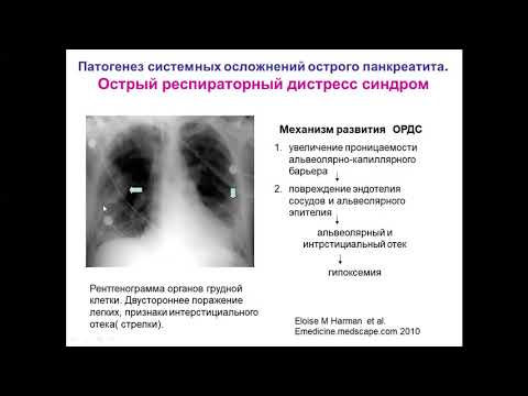 Видео: Лекция: Мультидисциплинарный подход к лечению острого и хронического панкреатита