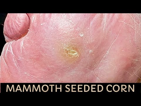 Видео: ОСТРОЕ РАССЕЯНИЕ ГЛУБОКОЙ МОЗОЛЫ