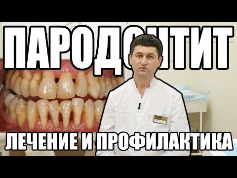 Видео: ПАРОДОНТИТ. Причины и Лечение
