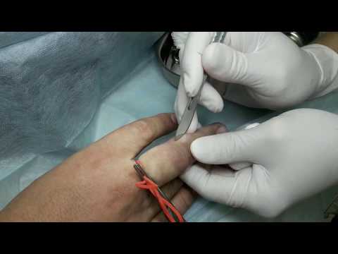 Видео: Удаление теносиновиомы пальца. Анестезия "взяла" не сразу...