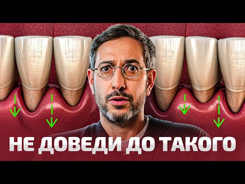 Видео: Начала уменьшаться десна, что делать? Лечение рецессии десны