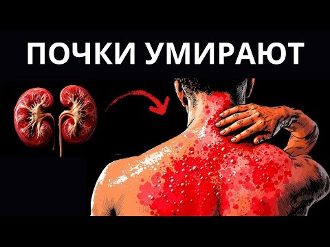 Видео: ПРИЗНАКИ ТОГО, ЧТО ВАШИ ПОЧКИ УМИРАЮТ!!