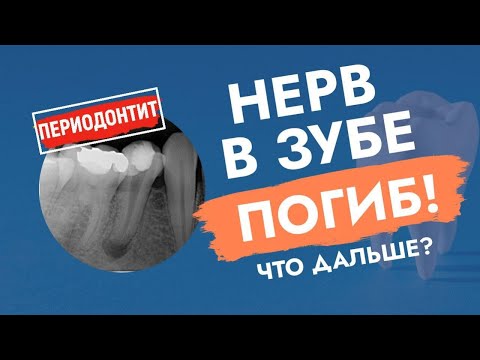 Видео: Нерв в зубе погиб. Что дальше?