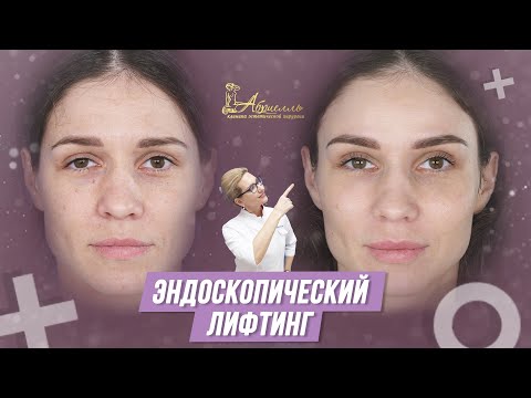 Видео: Зачем нужен эндоскопический лифтинг средней зоны лица и бровей?