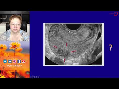 Видео: Экспертология | Сочетанная патология: миома + аденомиоз